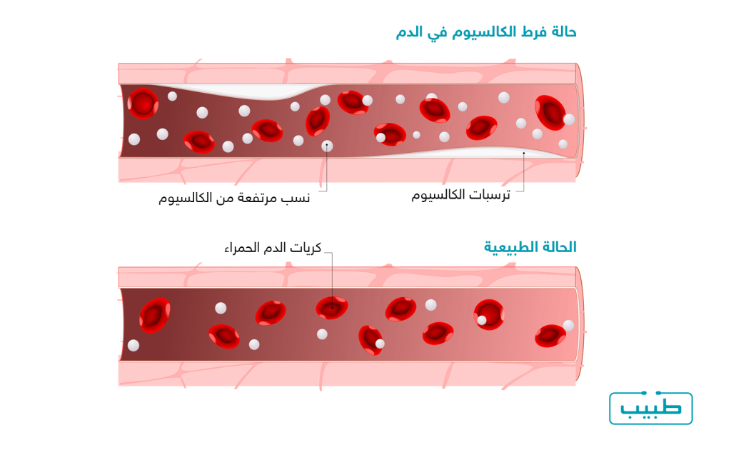 مقطع يوضح حالة فرط الكالسيوم في الدم