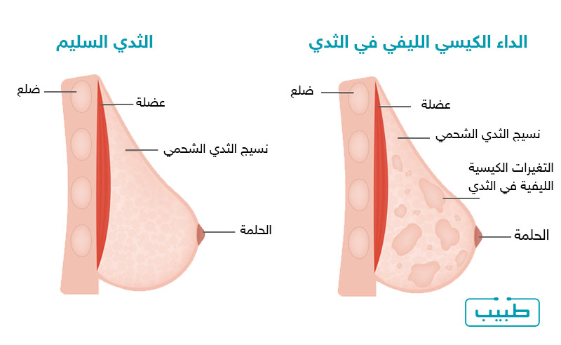 التغيرات الكيسية الليفية في بنية الثدي