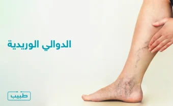 الدوالي الوريدية تظهر بشكل واضح على ساق القدم