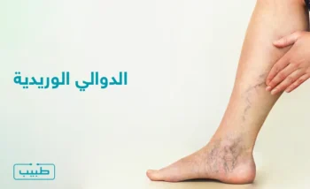 الدوالي الوريدية تظهر بشكل واضح على ساق القدم