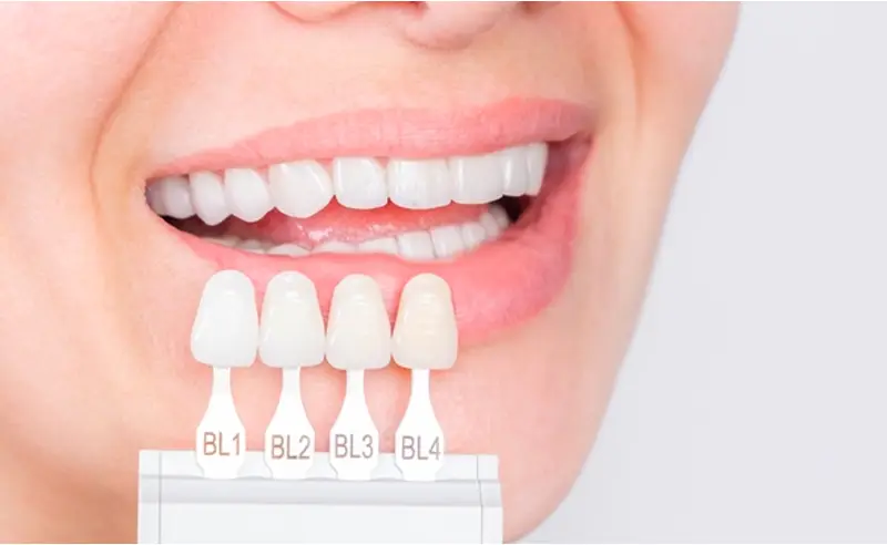 طرق تبييض الأسنان بشكل فعال
