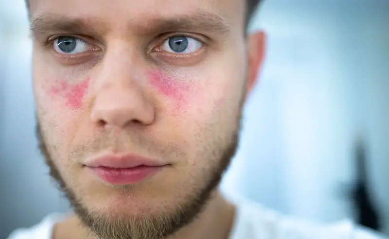 رجل يعاني من الذئبة الحمامية الجهازية وتظهر الأعراض على الوجه بوضوح