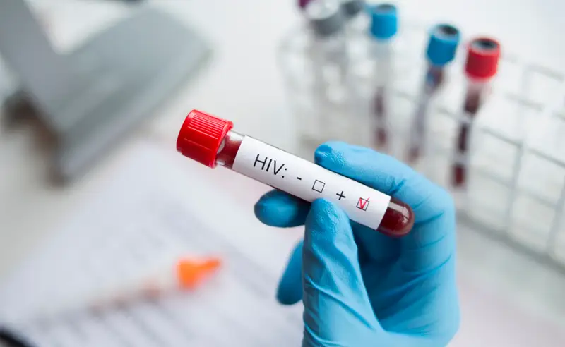 اختبار اختبار فيروس نقص المناعة البشرية من الاختبارات التشخيصية الهامة
