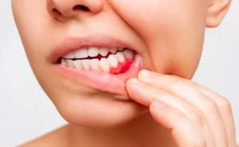 يمكن أن تؤدي حالة التهاب دواعم الأسنان في حال إهمالها إلى تساقط الأسنان
