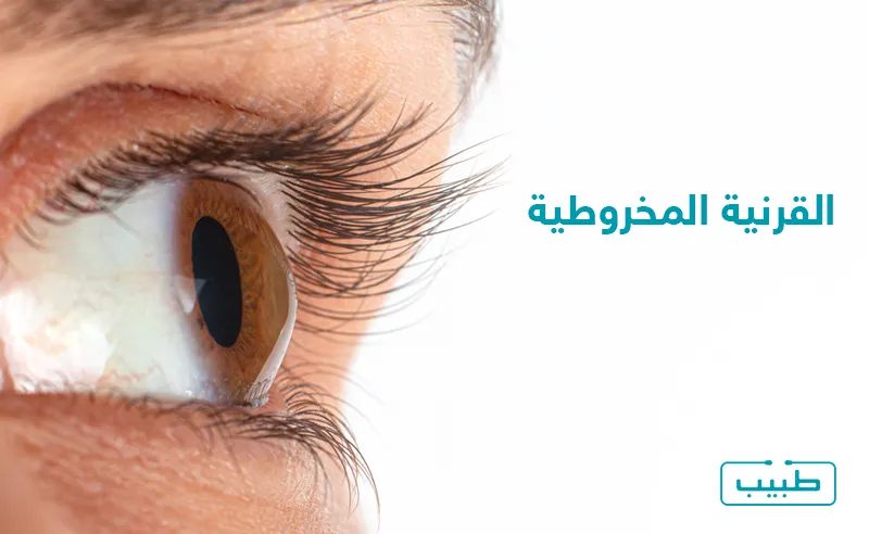 تتركز أعراض القرنية المخروطية حول مشاكل الرؤية والتي يمكن أن تتدهور مع إهمال العلاج