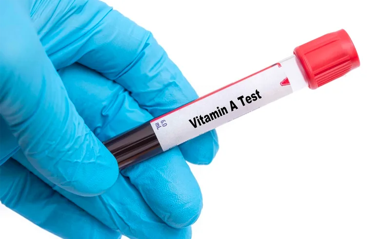 يطلب الطبيب اختبار فيتامين أ عندما يلاحظ وجود أعراض تشير إلى نقص نسبتة في الدم