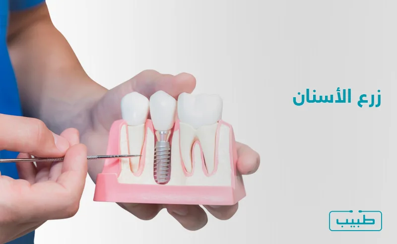إن الالتزام بالعادات الصحية للفم والأسنان أمر أساسي، في حال قرر المريض الخضوع لعملية زراعة الأسنان