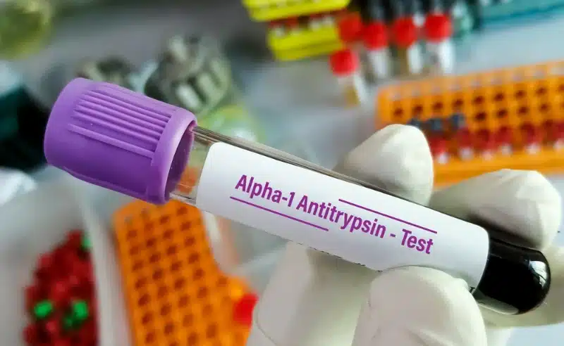 أنزيم ألفا-1 أنتي تريبسين يعتبر عامل وقائي من الإصابة بالأمراض التنفسية