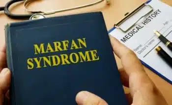 متلازمة مارفان هي مرض وراثي يصيب الأنسجة الضامة