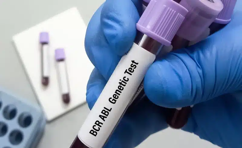 يمكن إجراء اختبار الجين BCR-ABL 1 على عينات متنوعة من الجسم مثل الدم أو نقي العظام