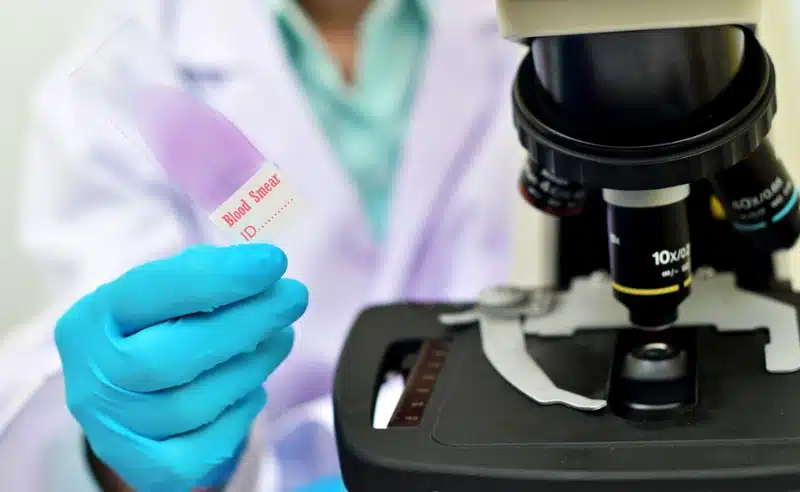 يقدم اختبار مسحة الدم معلومات عديدة عن خلايا الدم وتشخيص بعض أمراض الدم