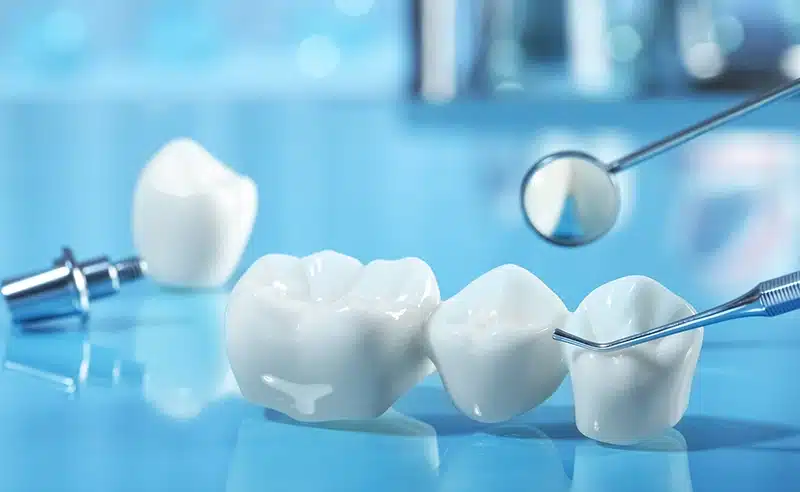 يعد زرع الأسنان أو جسور الأسنان طريقتين جيدتين لتعويض خسارة الأسنان