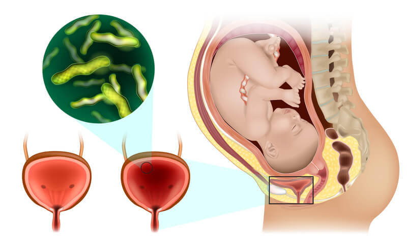 يمكن أن يؤدي توسع الرحم خلال الحمل إلى الإصابة بعدوى المسالك البولية