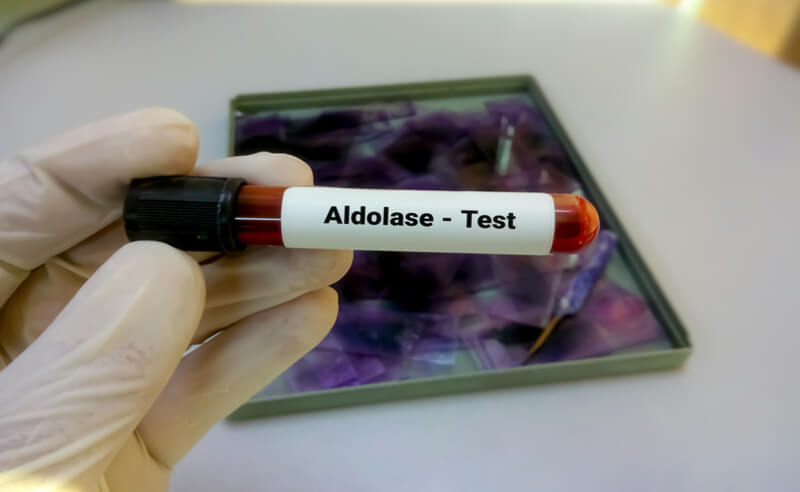 عينة دم في المختبر لاختبار الألدولاز