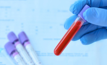 عينة دم في أنبوب لاختبار الأنزيم القالب للأنجيوتنسين
