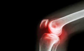 مفصل الركبة يعتبر الاكثر عرضة للاصابة بالتهاب المفاصل الانتاني