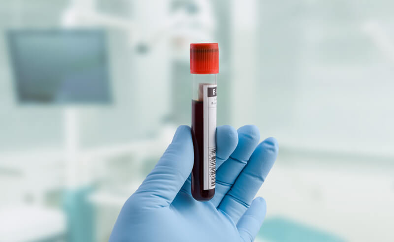 طبيب يجري تحليل دم خاص بتحليل الغلوبولين المناعي المنبه للغدة الدرقية