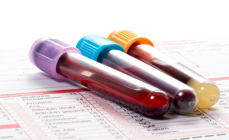 عينات دم لاختبار الأجسام المضادة لمستقبلات TSH